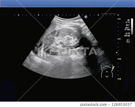 腎臟超音波檢查醫學影像 腎臟超音波檢查醫學影像 126953037
