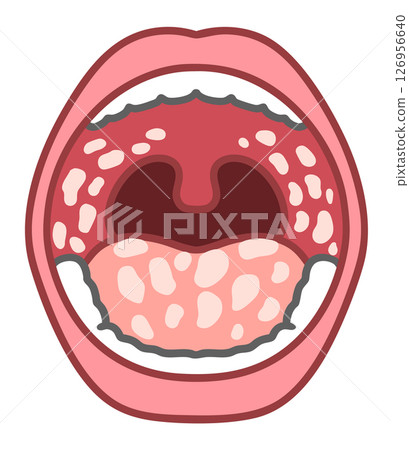 In the mouth with oral candidiasis: visual characteristics of a fungal infection In the mouth with oral candidiasis: visual characteristics of a fungal infection 126956640
