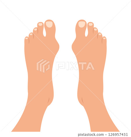 Human feet with deformities of big toe joint. Top view of bare feet with Hallux valgus deformation. Vector illustration 126957431