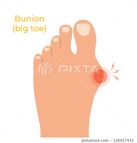 Human foot with deformities of big toe joint. Bare foot with Hallux valgus deformation. Vector illustration Human foot with deformities of big toe joint. Bare foot with Hallux valgus deformation. Vector illustration 126957432