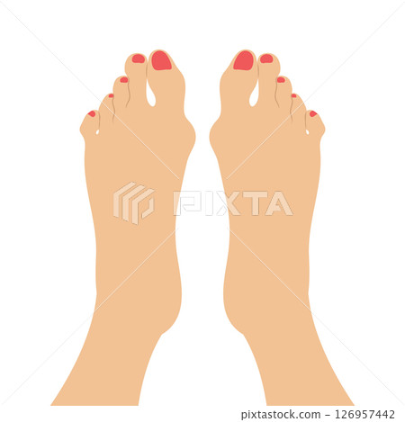 Women feet with a Hallux valgus deformation. Bunion of a big toe. Vector illustration Women feet with a Hallux valgus deformation. Bunion of a big toe. Vector illustration 126957442