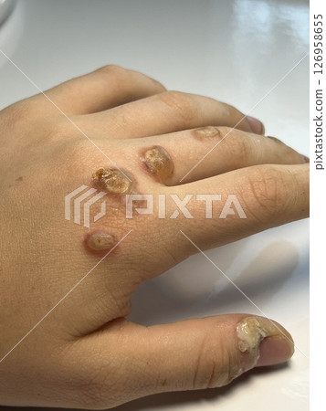 remove warts on hands process Hand with many scars after wart removal by chemical freezing. Damage to skin. Dermatology operation and treatment. White background. Process of removing skin defect. 126958655