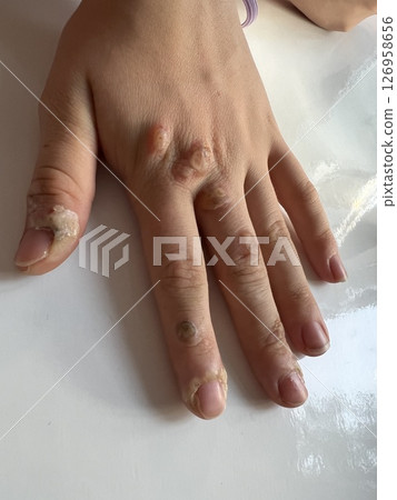remove warts on hands process Hand with many scars after wart removal by chemical freezing. Damage to skin. Dermatology operation and treatment. White background. Process of removing skin defect. remove warts on hands process Hand with many scars after wart removal by chemical freezing. Damage to skin. Dermatology operation and treatment. White background. Process of removing skin defect. 126958656