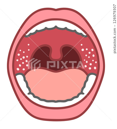 Illustration of measles in the mouth and Koplik spots 126979307