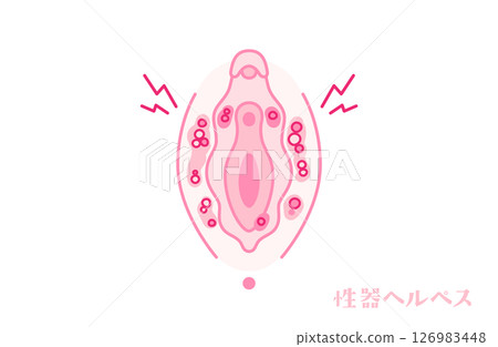 患有生殖器皰疹的女性生殖器（外陰部） 126983448