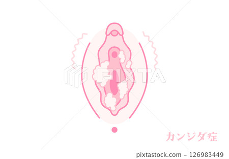 患有陰道念珠菌病的女性生殖器（外陰部） 126983449