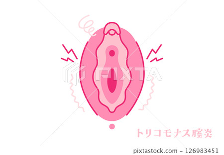 患有滴蟲性陰道炎的女性生殖器(外陰部) 患有滴蟲性陰道炎的女性生殖器(外陰部) 126983451