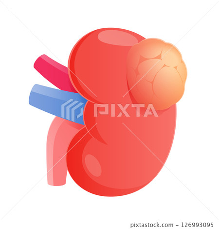 Illustration of a sad kidney with a visible kidney tumor. 126993095
