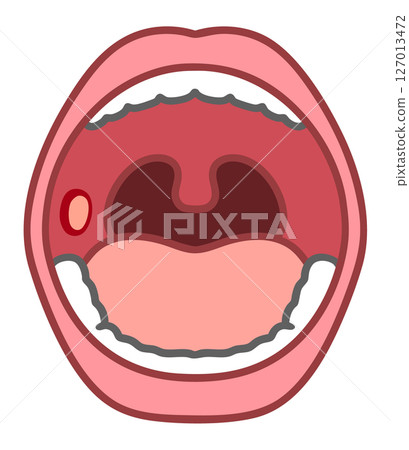 Mouth ulcers Mouth ulcers 127013472