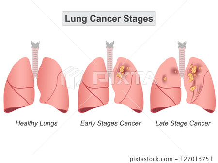 Lung cancer staging helps determine how much the cancer has spread. 127013751