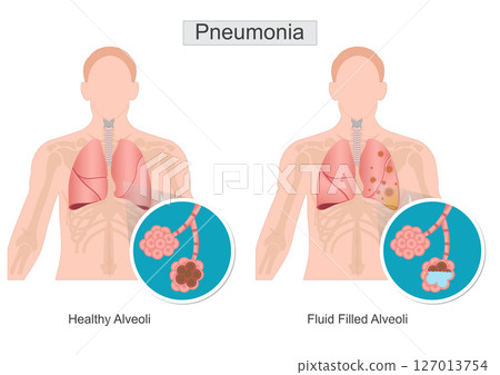 Pneumonia is inflammation and fluid in lungs. Pneumonia is inflammation and fluid in lungs. 127013754