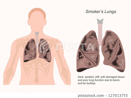 Smokers lungs are often gray or black. Smokers lungs are often gray or black. 127013755