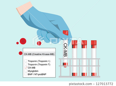 CK MB levels can help identify a reinfarction shortly after the first heart attack. CK MB levels can help identify a reinfarction shortly after the first heart attack. 127013772