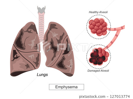 Emphysema is a chronic lung condition 127013774