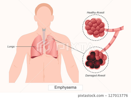 Emphysema is a long-term lung condition that causes shortness of breath. 127013776