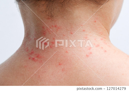 Red rashes from the Coxsackie virus on a child back. Chicken pox allergy symptoms on skin on children's body close-up Red rashes from the Coxsackie virus on a child back. Chicken pox allergy symptoms on skin on children's body close-up 127014279