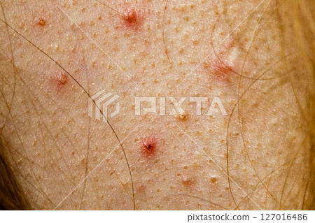 Closeup skin with acne moles and red spots. 127016486