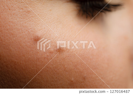 Part of woman face with mole close up 127016487