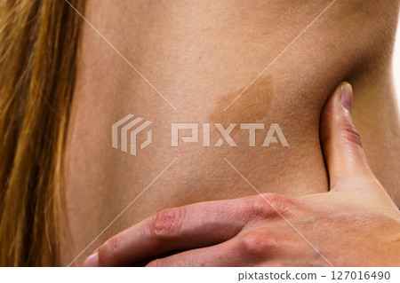 Closeup of brown birthmark on skin 127016490