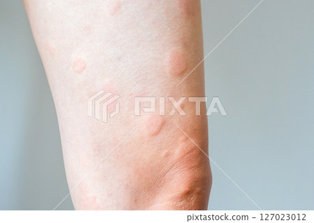 Young asian man has allergic skin rash on his legs from itchy dry skin eczema dermatitis insect bites Young asian man has allergic skin rash on his legs from itchy dry skin eczema dermatitis insect bites 127023012