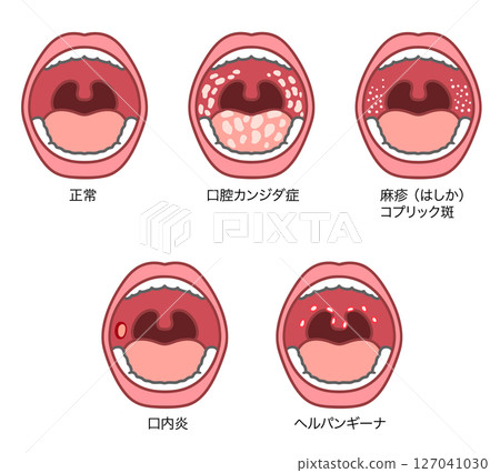 Illustration set of symptoms in the oral cavity 127041030