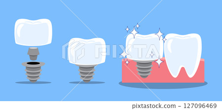 Dental implant structure and prodecure . Tooth cartoon illustration . Isolated on blue background . Vector . 127096469