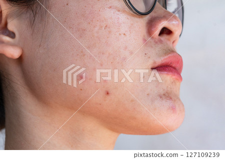 Cropped shot view of Asian woman having skin problem such as acne, scar, wrinkled occur on her face. Allergies, irritants, genetic makeup, etc can cause skin conditions. Cropped shot view of Asian woman having skin problem such as acne, scar, wrinkled occur on her face. Allergies, irritants, genetic makeup, etc can cause skin conditions. 127109239