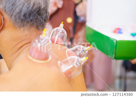 Close up for multiple vacuum cups, medical cupping therapy on human body. Doctor with cups for patient, therapy. Wellness, health injury rehabilitation concept. Alternative medicine 127114380