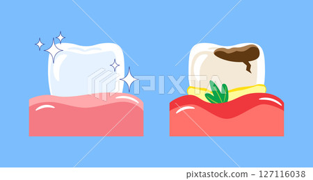 Periodontal disease . Included gingivitis, dental calculus, gum recession and food stuck in teeth . Cartoon illustration . Isolated on blue background . Vector . 127116038