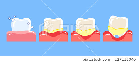 Periodontal disease . Included gingivitis, dental calculus, gum recession and food stuck in teeth . Cartoon illustration . Isolated on blue background . Vector . Periodontal disease . Included gingivitis, dental calculus, gum recession and food stuck in teeth . Cartoon illustration . Isolated on blue background . Vector . 127116040