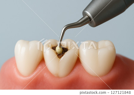 Treating tooth decay Treating tooth decay 127121848
