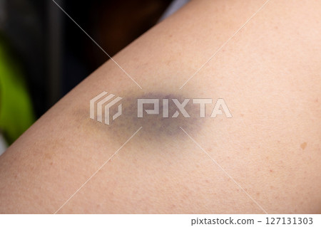 Closeup image of an arm showing a purple spot on it 127131303