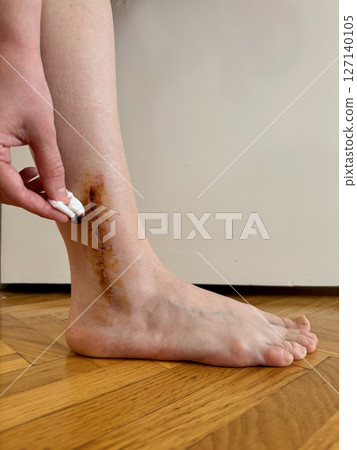 Close-up photo of healing post-surgical scar on the right ankle with of iodine solution applied with a cotton swab. Concept of wound care, disinfection, and recovery after surgery. Close-up photo of healing post-surgical scar on the right ankle with of iodine solution applied with a cotton swab. Concept of wound care, disinfection, and recovery after surgery. 127140105