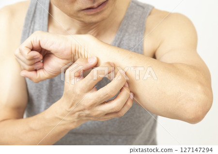 Man scratching insect bites on white background 127147294