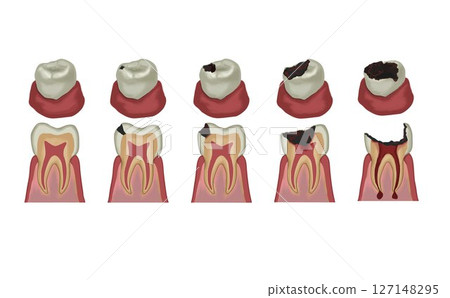 蛀牙階段的圖示 蛀牙階段的圖示 127148295