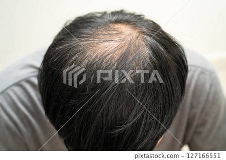 Bald in the middle head and begin no loss hair glabrous of mature Asian business smart active office man. Bald in the middle head and begin no loss hair glabrous of mature Asian business smart active office man. 127166551