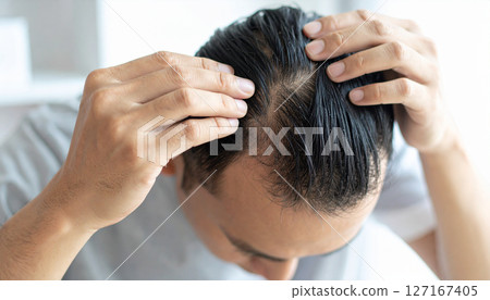 一名男子擔心頭髮稀疏(人工智慧生成的圖像) 一名男子擔心頭髮稀疏(人工智慧生成的圖像) 127167405