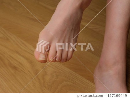 Close-up of a woman s foot with hallux valgus bunion and signs of toenail fungus. Her hand gently touches the deformed big toe, illustrating common foot problems and the need for medical care. 127169449