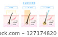 Types of hair removal: Photoepilation, laser hair removal, needle hair removal 127174820