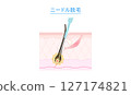 Cross-section of needle hair removal mechanism 127174821