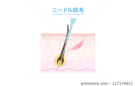 Cross-section of needle hair removal mechanism Cross-section of needle hair removal mechanism 127174821