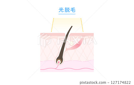 Cross-sectional diagram of the mechanism of laser hair removal and beauty salon hair removal Cross-sectional diagram of the mechanism of laser hair removal and beauty salon hair removal 127174822