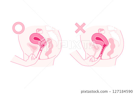 Correct and incorrect insertion of vaginal tablets Correct and incorrect insertion of vaginal tablets 127184590