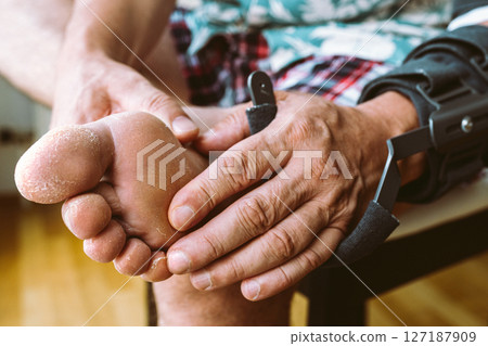 man scratches and scratches dry, cracked skin feet man scratches and scratches dry, cracked skin feet 127187909