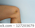Bruised Knee on Male Leg 127203679