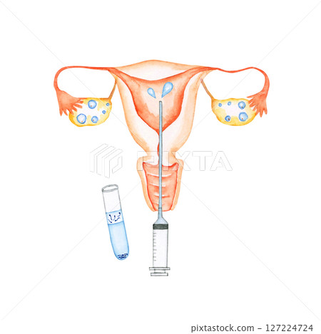 Infertility treatment, pregnancy, uterus, artificial insemination, syringe method, watercolor illustration 127224724