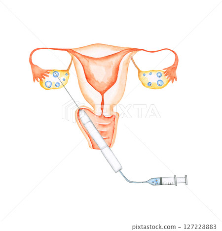 不孕症治療、懷孕、子宮、體外受精、卵子採集、水彩插圖 127228883