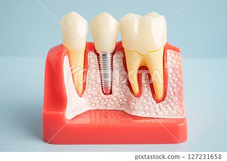 Dental implant, artificial tooth roots into jaw, root canal of dental treatment, gum disease, teeth model for dentist studying about dentistry. 127231658