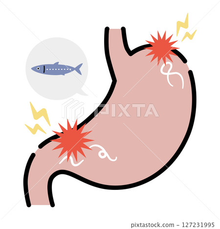 Stomach infected with Anisakis 127231995