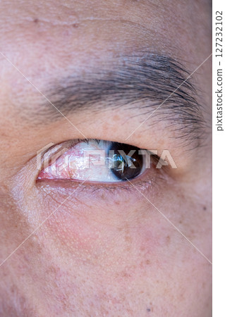 Close-Up of Human Eye Showing Symptoms of Glaucoma 127232102